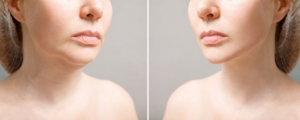 double chin liposuction