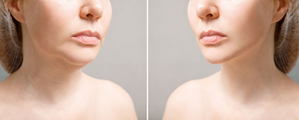 double chin liposuction