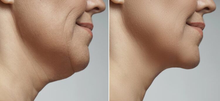 double chin liposuction