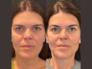 Best Plastic Surgeon in Dubai Providing Trusted Thread Lift Treatments for Patients