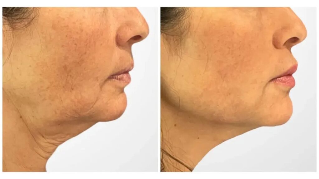 Best Aesthetic Clinics in Dubai Specialize Thread Lift For Skin Rejuvenation