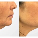 Best Aesthetic Clinics in Dubai Specialize Thread Lift For Skin Rejuvenation