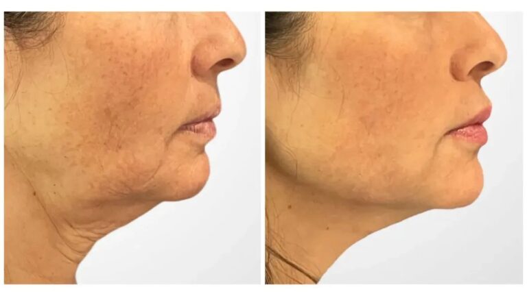 Best Aesthetic Clinics in Dubai Specialize Thread Lift For Skin Rejuvenation