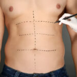 tummy tuck surgery in islamabad