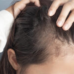 Personalized Hair Loss Consultation Dallas/Private Hair Loss Consultation Dallas