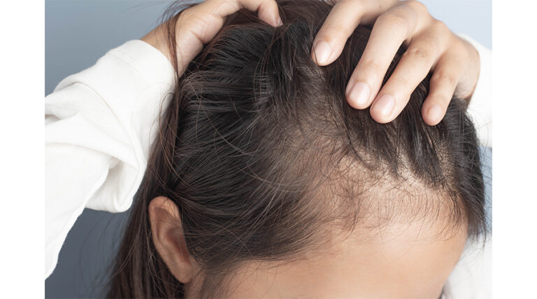 Personalized Hair Loss Consultation Dallas/Private Hair Loss Consultation Dallas