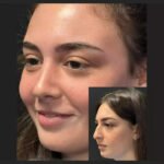 Rhinoplasty in Dubai