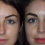 Septoplasty in Dubai