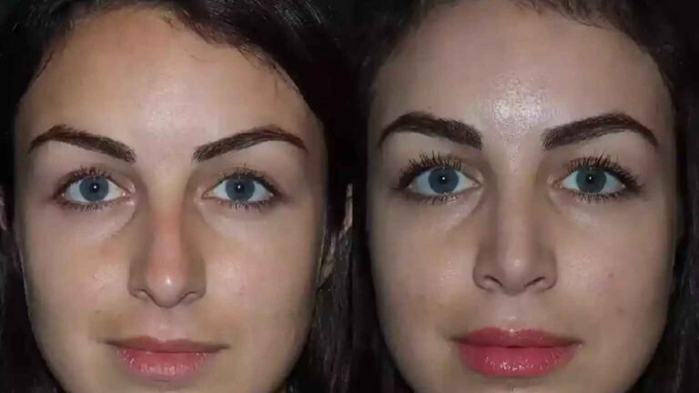 Septoplasty in Dubai