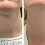 Radiofrequency (RF) Microneedling Treatment in Dubai for Healthier-Looking Skin