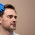 PRP with microneedling