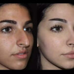 Rhinoplasty in Dubai