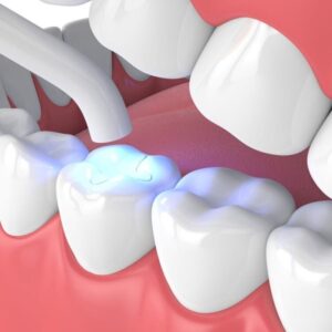 Teeth Filling