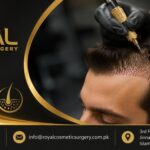 dhi hair transplant