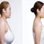 Breast Reduction in Dubai