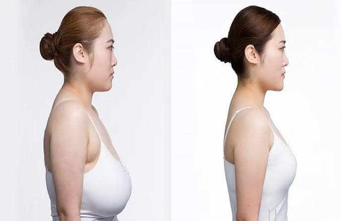 Breast Reduction in Dubai