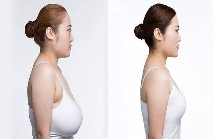 Breast Augmentation Surgery