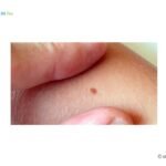 mole removal