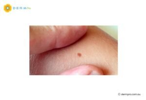mole removal