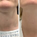 Best Aesthetic Clinic in dubai for Acne Scar Radiofrequency Microneedling