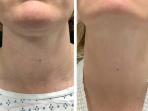 Best Aesthetic Clinic in dubai for Acne Scar Radiofrequency Microneedling