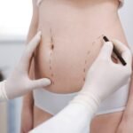 Liposuction in Dubai