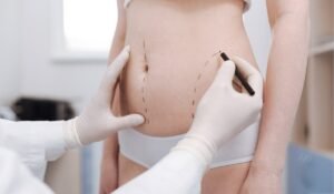 Liposuction in Dubai