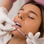 lip injections Toronto