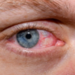 Dry Eye Syndrome in Delhi