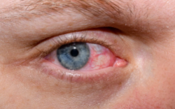 Dry Eye Syndrome in Delhi