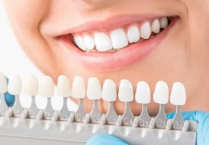 dental-veneers-clinic-dubai