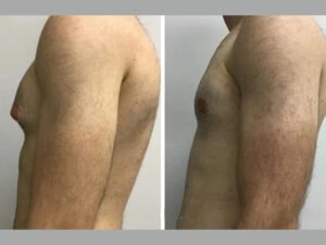 Gynecomastia Surgery in Dubai