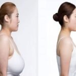 Breast implant removal surgery in Dubai