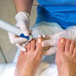 laser treatment Townsville
