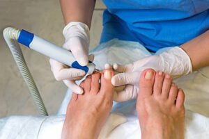 laser treatment Townsville