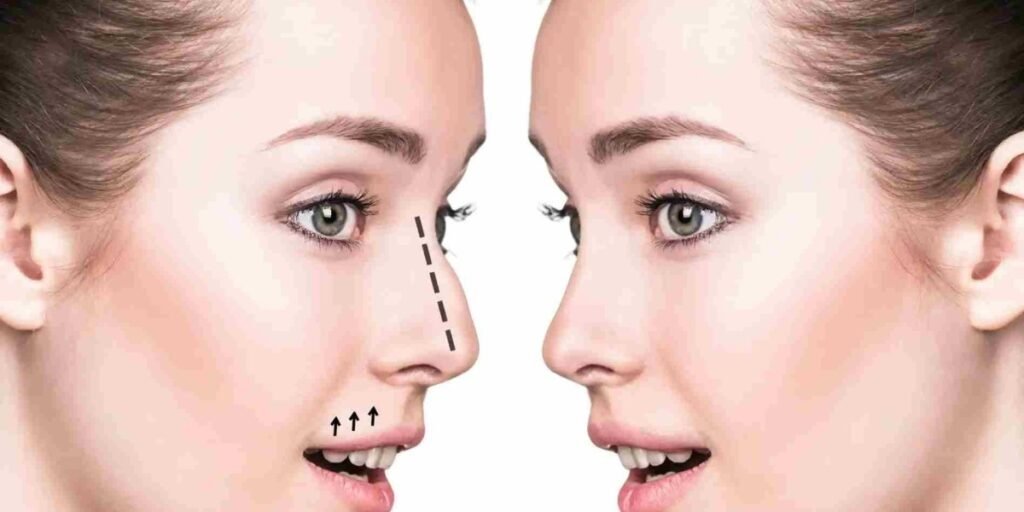 rhinoplasty in dubai