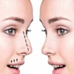 rhinoplasty in dubai