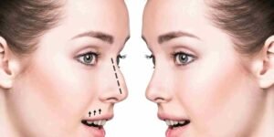 rhinoplasty in dubai