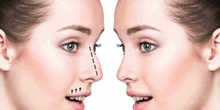 rhinoplasty in dubai