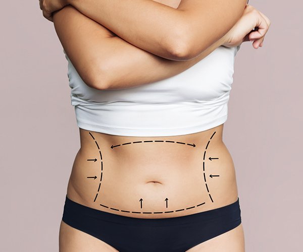 tummy-tuck-surgery-2