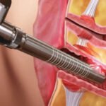 Vaginal Rejuvenation Treatment