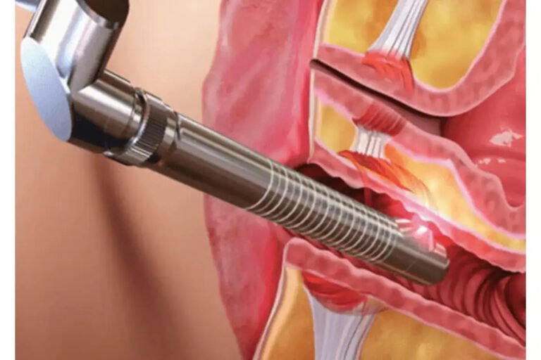 Vaginal Rejuvenation Treatment