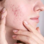 Acne-Scars