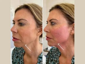Best Aesthetic Clinics in dubai providing effective Endolift anti aging