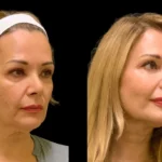 H5-Cheek-Fillers (1)
