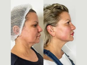 Endolift Treatment in Dubai for Advanced Jawline Sculpting Results