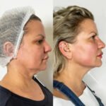 Best Doctors in dubai for Modern Endolift Laser Rejuvenation Treatments
