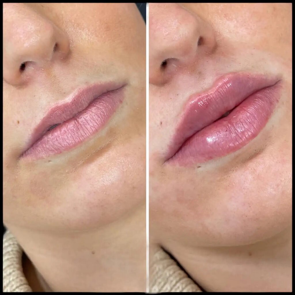 H7-lip-fillers