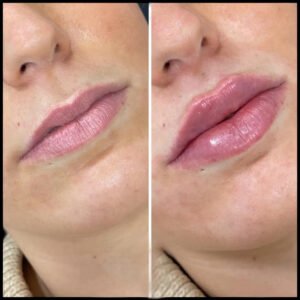 H7-lip-fillers