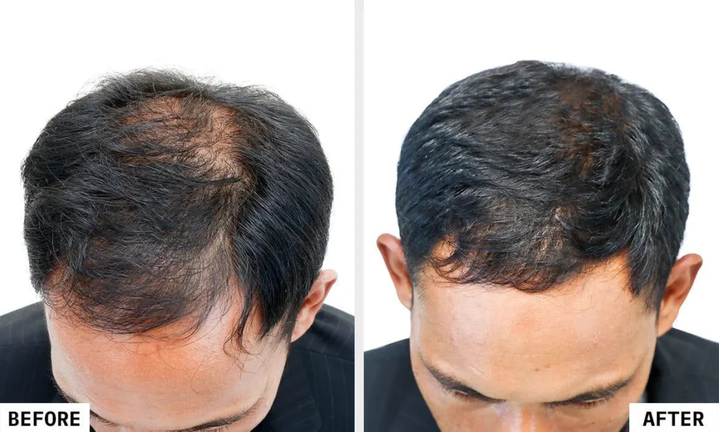 Laser Hair Reduction Treatment in Guwahati at Essence Skin Care